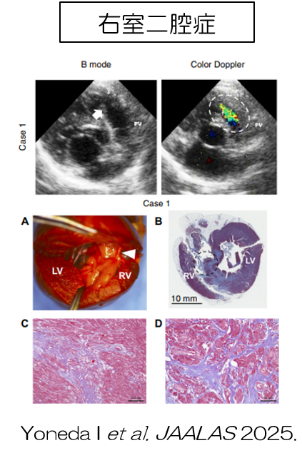 右室二腔症の研究