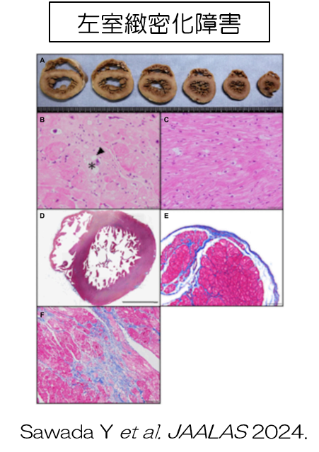 左室緻密化障害の研究